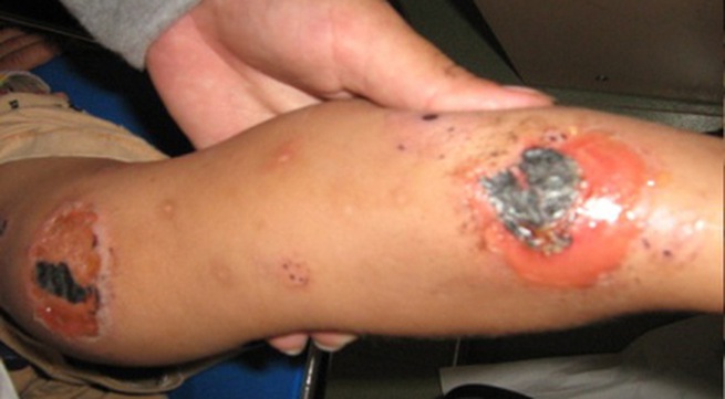 Chốc lở - Hình ảnh minh họa